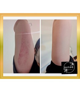 ひぺりかむ/3ステップエステ