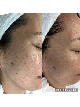 ラズ(Luz)/シミケア！