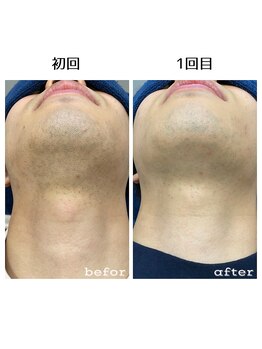 シャルム(Charme)/メンズひげ脱毛