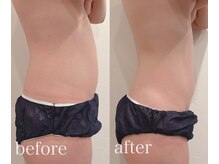 シンシアリー 広瀬通店(Sincerely)/before→after【お腹】