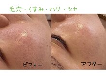 ビューティースパ/白さ倍増☆ホワイトスノーピール