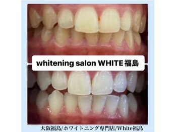 ホワイトニングサロン ホワイト(WHITE)/セルフホワイトニング/大阪/福島