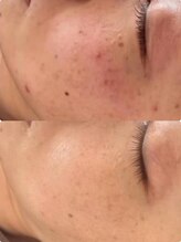 ラエッセ 恵比寿(LAESSE)/毛穴・美白専門店 LAESSE 恵比寿