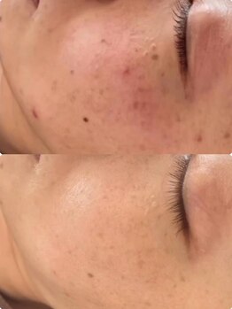 ラエッセ 恵比寿(LAESSE)/毛穴・美白専門店 LAESSE 恵比寿