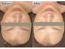 あすはれ/1回でも効果抜群ララピール