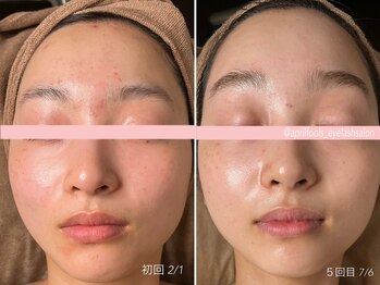 エイプリルフールズ(April fools)/【20代】繰り返す生え際のニキビ