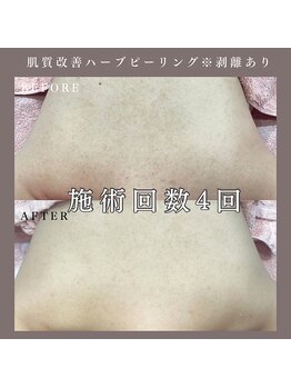 ベルミー(Bellmi)/肌質改善ハーブピーリング(背中)