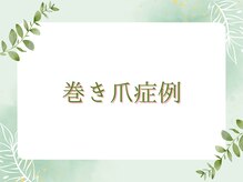 イルミナ(illumina)/当院の巻き爪矯正の成果