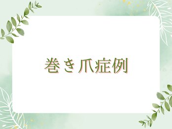 イルミナ(illumina)/当院の巻き爪矯正の成果
