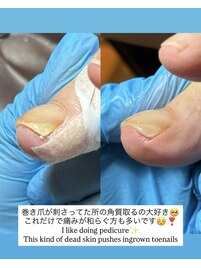 巻き爪ケアジェル