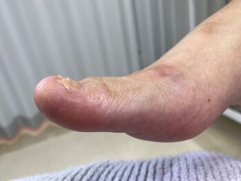 フットメンテ 巻き爪矯正センター 南浦和/肥厚爪　ケア後