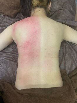 リベル(Liber)/背中のハリでつらい方はリリース