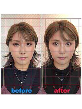 ルディア 堂島店(ledia)/西梅田美容鍼1回での変化