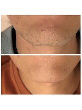 マジカルココ 東久留米店(マジカルCoCo)/男性脱毛に特化！国産マシン導入