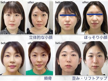美デザイン 仙台店(美.design)/☆小顔矯正Before-After