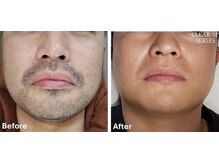 ラッシュ(RUSH)/10回でヒゲ脱毛完了！