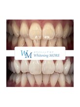 ホワイトニング モア(Whitening MORE)/ビフォーアフター