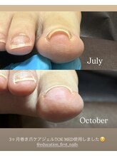 ネイルズ バイ ユイ 外苑前(Nails by Yui)/巻き爪ケアジェル