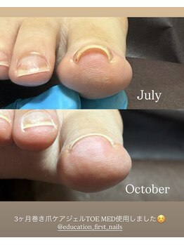 ネイルズ バイ ユイ 外苑前(Nails by Yui)/巻き爪ケアジェル