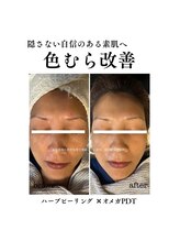 成宮鍼灸整骨院/ビフォーアフター（色むら改善）