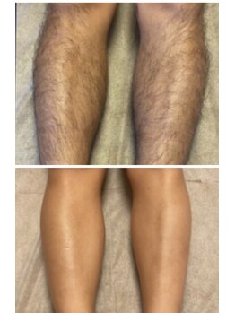 メモリー(memory)/足脱毛【ビフォーアフター】