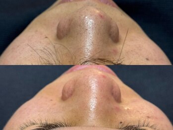 リアン 本町(Lien.)/黒ずみも一回でこんなに！？