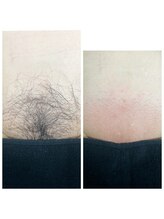 アットユウ(@yu)/シュガーリング《VIO》