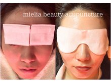 ミエリア美容鍼灸院(mielia美容鍼灸院)/幹細胞美容鍼灸(幹細胞FACIA)