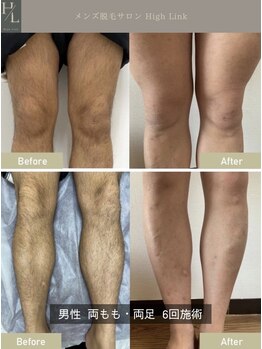 ハイリンク(High Link)/《両脚脱毛》before→after