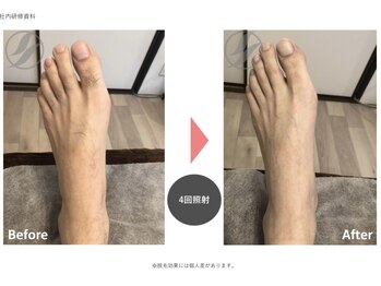 リネ(Rine)/before→after