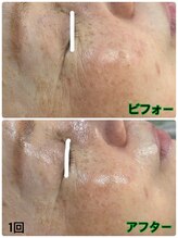 ダオン(DAON)/ラミネーションピール