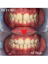 ボリューミー(Volum-me)/１トーンから２トーンの白さ