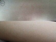 ヴィオール 名古屋栄店(VIOR)/【レデイース脱毛】　ひじ上