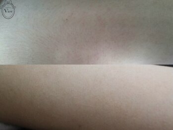 ヴィオール 名古屋栄店(VIOR)/【レデイース脱毛】 ひじ上