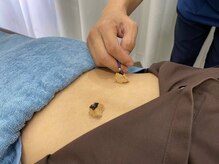 五反田駅前鍼灸整体院/やさしいお灸施術