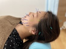 あおき鍼灸整骨院/肩こり/腰痛/整体の雰囲気(鍼で深部までアプローチ!)