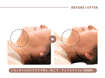 イエス マイサロン(yes My Salon)/レモンボトル施術例