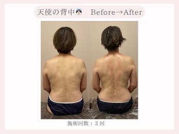 ミロン(miron)/天使の背中（BeforeAfter）