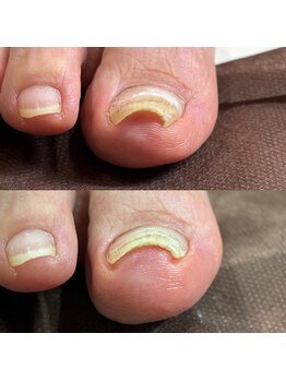 リリ(lili)/巻き爪矯正3回目(右親指)