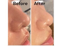 シェリマ 西新宿(cheri.ma)/生プラセンタフェイシャル