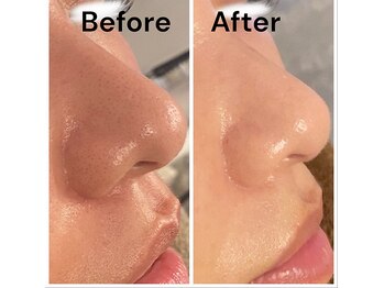 シェリマ 西新宿(cheri.ma)/生プラセンタフェイシャル