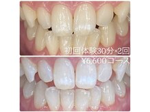 ホワイトニングルーム 横浜店(Whitening Room)/ホワイトニング/横浜