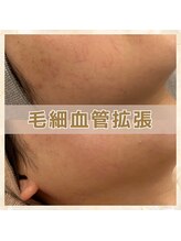 シーベル 新宿/ハーブピーリング/毛細血管ケア