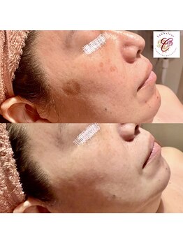 ラ シャルール 元町/シミ，シワに純粋レチノール