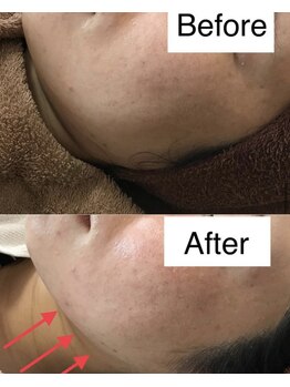 コウベ美容鍼灸治療院(KOBE美容鍼灸治療院)/たるみ改善２フェイスライン施術