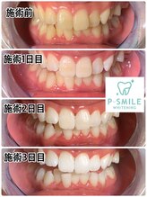 ホワイトベース(White Base)/before after