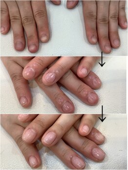 シャンネイルケアサロン(Shan Nail caresalon)の写真/地爪が薄くて、割れやすい方！二枚爪や深爪でお悩みの方！足の巻き爪など、お爪の悩みを改善いたします。