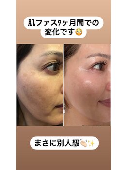 スパチャーレ(Spa ciare)/肌ファス