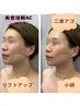 【二重アゴ/小顔/たるみケア】小顔美肌美容溶解トリートメント