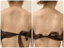 リリィブラン(Lily branc)/Body美白ピーリング/シミケア